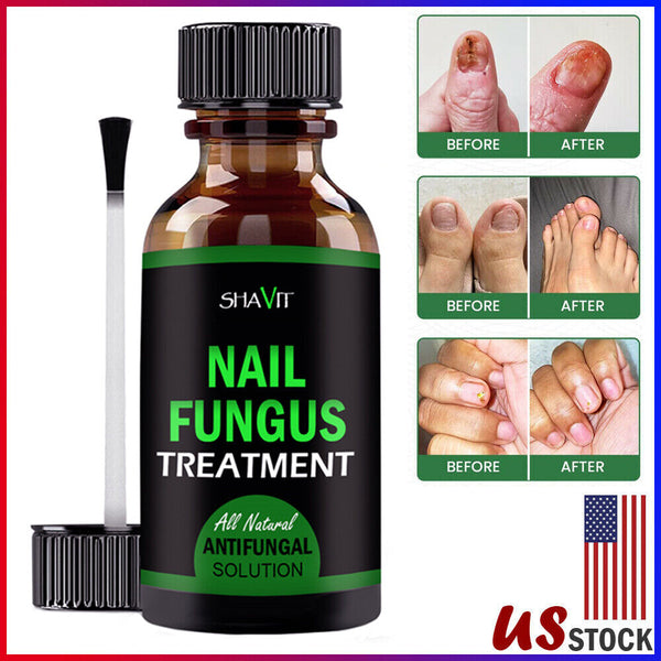 ANTI FUNGAL TREATMENT EXTRA STRENGTH TOENAIL FUNGUS ATHLETES FOOT FUNGI NAIL